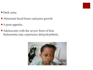  Dark urine
 Abnormal facial bones and poor growth
 A poor appetite.
 Adolescents with the severe form of beta
thalassemia may experience delayed puberty.
 
