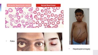 ▫ Hepatosplenomegaly
▫ Pallor
 
