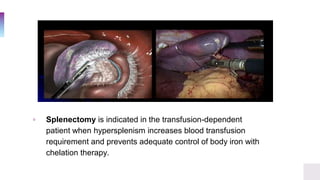 ▫ Splenectomy is indicated in the transfusion-dependent
patient when hypersplenism increases blood transfusion
requirement and prevents adequate control of body iron with
chelation therapy.
 