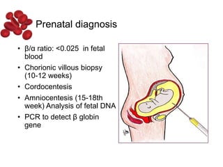• β/α ratio: <0.025 in fetal
blood
• Chorionic villous biopsy
(10-12 weeks)
• Cordocentesis
• Amniocentesis (15-18th
week) Analysis of fetal DNA
• PCR to detect β globin
gene
Prenatal diagnosis
 