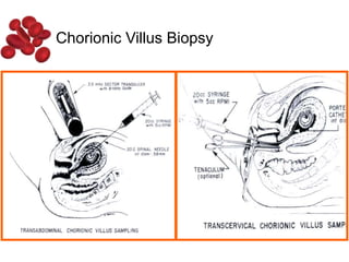 Chorionic Villus Biopsy
 