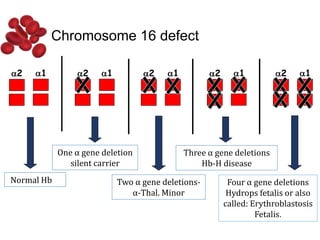 Chromosome 16 defect
2 1 2 1
2
2 1
2 1
2 1
2 1
2 1
2 1
Normal Hb
One α gene deletion
silent carrier
Two α gene deletions-
α-Thal. Minor
Four α gene deletions
Hydrops fetalis or also
called: Erythroblastosis
Fetalis.
Three α gene deletions
Hb-H disease
 