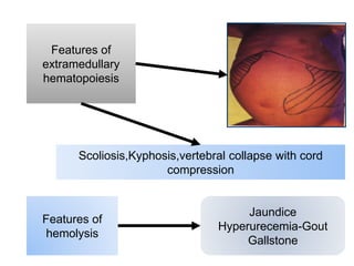 Features of
extramedullary
hematopoiesis
Features of
hemolysis
Jaundice
Hyperurecemia-Gout
Gallstone
Scoliosis,Kyphosis,vertebral collapse with cord
compression
 