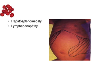 • Hepatosplenomegaly
• Lymphadenopathy
 