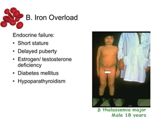 Endocrine failure:
• Short stature
• Delayed puberty
• Estrogen/ testosterone
deficiency
• Diabetes mellitus
• Hypoparathyroidism
B. Iron Overload
 