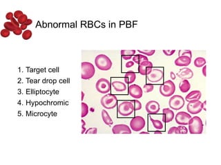 Abnormal RBCs in PBF
1. Target cell
2. Tear drop cell
3. Elliptocyte
4. Hypochromic
5. Microcyte
 