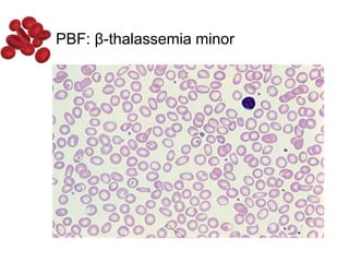 PBF: β-thalassemia minor
 