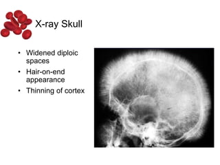 • Widened diploic
spaces
• Hair-on-end
appearance
• Thinning of cortex
X-ray Skull
 