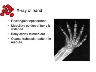• Rectangular appearance
• Medullary portion of bone is
widened
• Bony cortex thinned out
• Coarse trabecular pattern in
medulla
X-ray of hand
 
