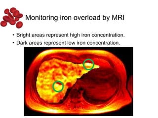 • Bright areas represent high iron concentration.
• Dark areas represent low iron concentration.
Monitoring iron overload by MRI
 
