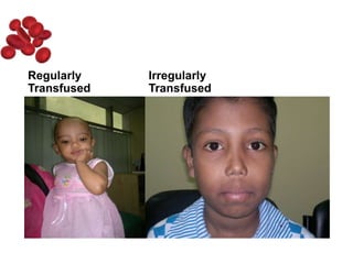 Regularly
Transfused
Irregularly
Transfused
 