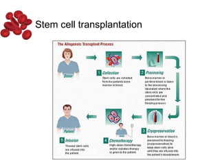Stem cell transplantation
 