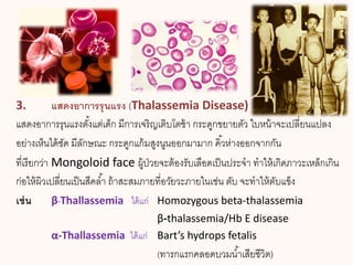 3. แสดงอาการรุนแรง (Thalassemia Disease)
แสดงอาการรุนแรงตั้งแต่เด็ก มีการเจริญเติบโตช้า กระดูกขยายตัว ใบหน้าจะเปลี่ยนแปลง
อย่างเห็นได้ชัด มีลักษณะ กระดูกแก้มสูงนูนออกมามาก คิ้วห่างออกจากกัน
ที่เรียกว่า Mongoloid face ผู้ป่วยจะต้องรับเลือดเป็นประจา ทาให้เกิดภาวะเหล็กเกิน
ก่อให้ผิวเปลี่ยนเป็นสีคล้า ถ้าสะสมภายที่อวัยวะภายในเช่น ตับ จะทาให้ตับแข็ง
เช่น β-Thallassemia ได้แก่ Homozygous beta-thalassemia
β-thalassemia/Hb E disease
α-Thallassemia ได้แก่ Bart’s hydrops fetalis
(ทารกแรกคลอดบวมน้าเสียชีวิต)
 