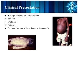 Clinical Presentation
 Shortage of red blood cells-Anemia
 Pale skin
 Weakness
 Fatigue
 Enlarged liver and spleen- hepatosplenomegaly
 