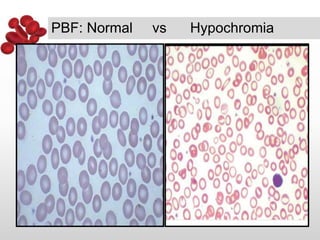 Thalassemia | PPTX