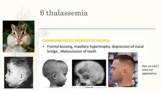 β thalassemia
Hair-on-end /
crew-cut
appearance
 