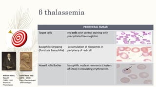 β thalassemia
PERIPHERAL SMEAR
Target cells red cells with central staining with
precipitated haemoglobin
Basophilic Stripping
(Punctate Basophilia)
accumulation of ribosomes in
periphery of red cell
Howell Jolly Bodies basophilic nuclear remnants (clusters
of DNA) in circulating erythrocytes.
William Henry
Howell
(1860- 1945)
American
Physiologists
Justin Marie Jolly
(1870 – 1953)
French hematologist
and histologist
 