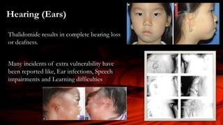 Hearing (Ears)
Thalidomide results in complete hearing loss
or deafness.
Many incidents of extra vulnerability have
been reported like, Ear infections, Speech
impairments and Learning difficulties
 