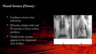 Nasal Issues (Nose) :
 Leading to many sinus
infections.
 Whereby simple colds and
flu become a more serious
problem.
 Thalidomide victims
appears to be depressed
nose bridges.
 