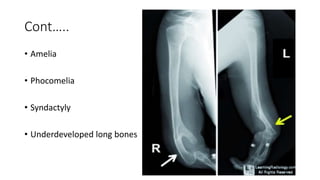 Cont…..
• Amelia
• Phocomelia
• Syndactyly
• Underdeveloped long bones
 