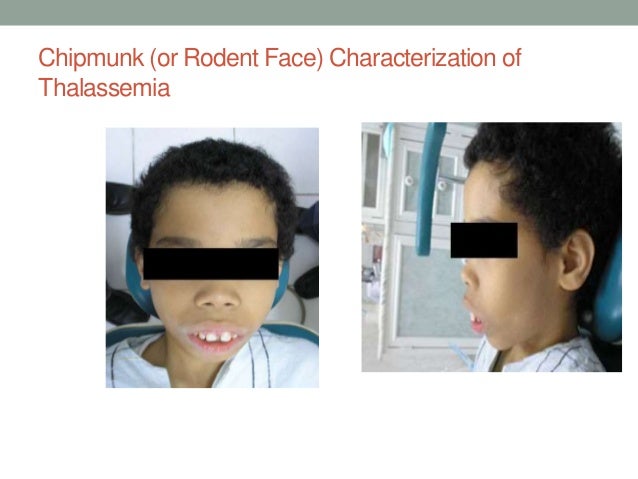 Thallessemia thallessemia