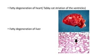 • Fatty degeneration of heart( Tabby cat striation of the ventricles)
• Fatty degeneration of liver
 