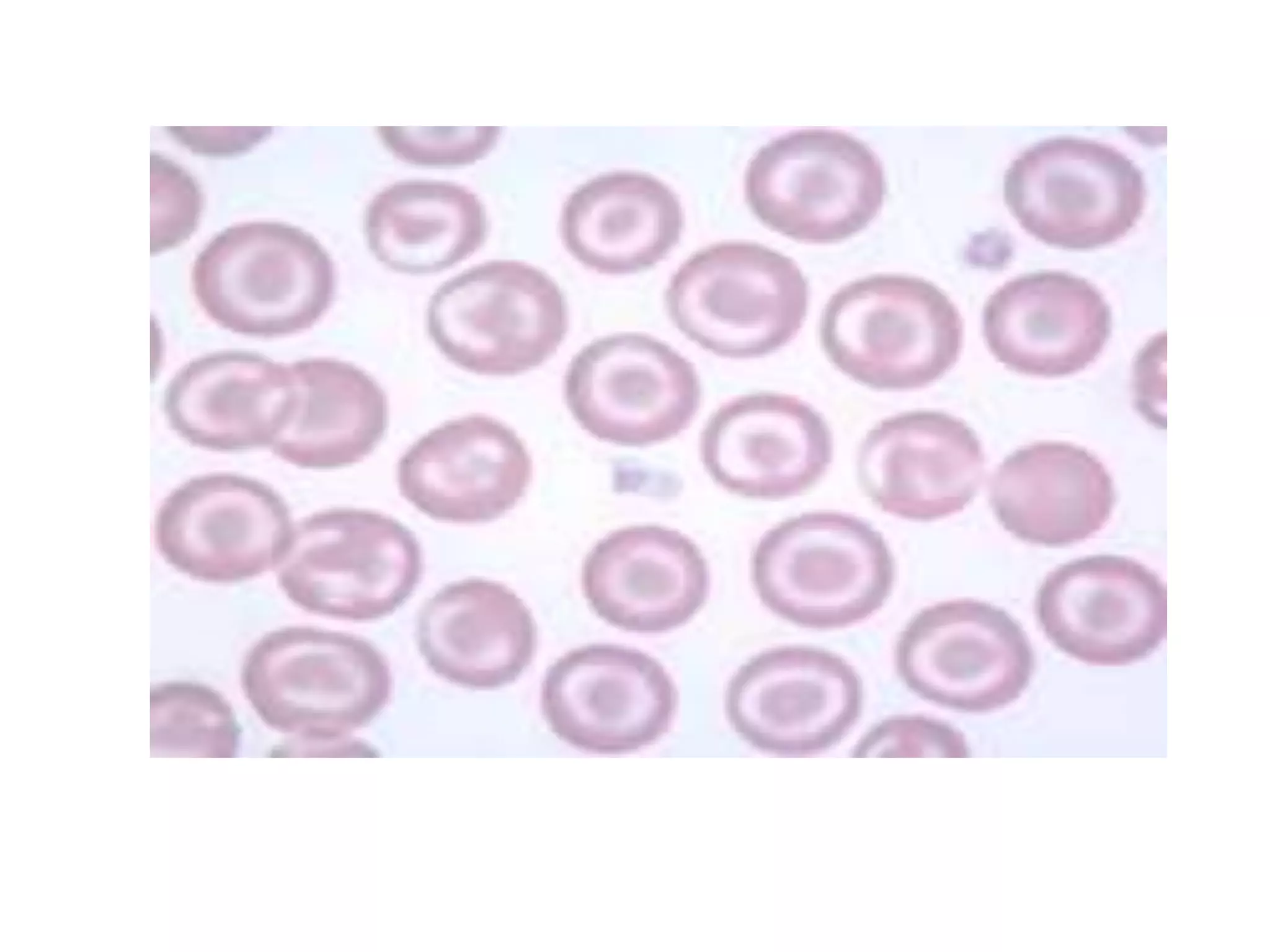 thalassemia and sickle cell disease | PPT