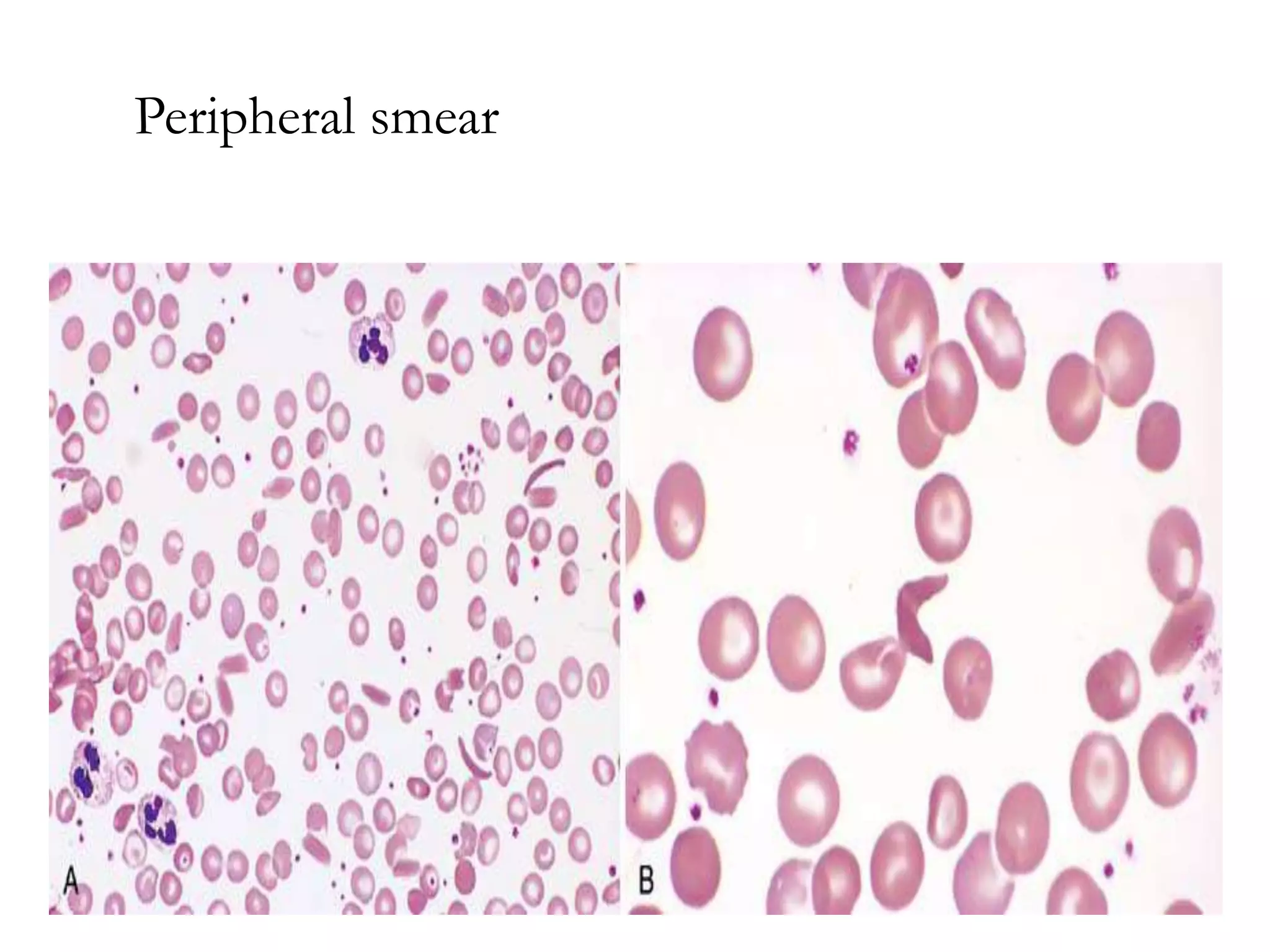 thalassemia and sickle cell disease | PPT