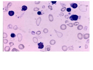 thalassemia and sickle cell disease | PPT