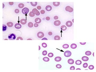 thalassemia and sickle cell disease | PPT