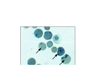 thalassemia and sickle cell disease | PPT