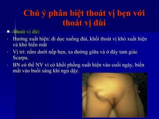 Chú ý phân biệt thoát vị bẹn với thoát vị đùi Thoát vị đùi: Hướng xuất hiện: đi dọc xuống đùi, khối thoát vị khó xuất hiện và khó biến mất Vị trí: nằm dưới nếp bẹn, xa đường giữa và ở đáy tam giác Scarpa. BN có thể NV vì có khối phồng xuất hiện vào cuối ngày, biến mất vào buổi sáng khi ngủ dậy. 