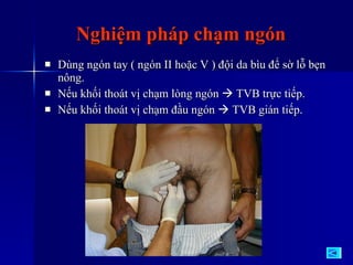 Nghiệm pháp chạm ngón Dùng ngón tay ( ngón II hoặc V ) đội da bìu để sờ lỗ bẹn nông. Nếu khối thoát vị chạm lòng ngón    TVB trực tiếp. Nếu khối thoát vị chạm đầu ngón    TVB gián tiếp. 