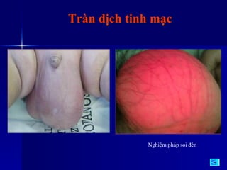 Tràn dịch tinh mạc Nghiệm pháp soi đèn 