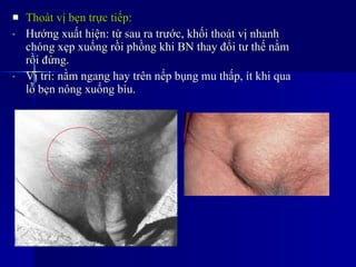 Thoát vị bẹn trực tiếp: Hướng xuất hiện: từ sau ra trước, khối thoát vị nhanh chóng xẹp xuống rồi phồng khi BN thay đổi tư thế nằm rồi đứng. Vị trí: nằm ngang hay trên nếp bụng mu thấp, ít khi qua lỗ bẹn nông xuống bìu. 