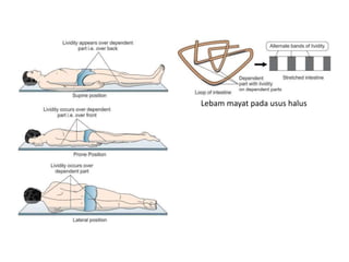 Lebam mayat pada usus halus
 