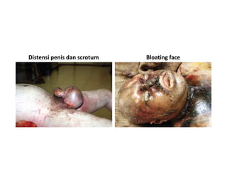 Distensi penis dan scrotum Bloating face
 