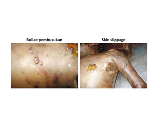 Bullae pembusukan Skin slippage
 