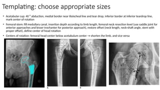 Templating: choose appropriate sizes
• Acetabular cup: 40 ⁰ abduction, medial border near ilioischeal line and tear drop, inferior border at inferior teardrop line,
mark center of rotation
• Femoral stem: fill medullary canal, insertion depth according to limb length, femoral neck resection level (use saddle joint for
anterior approaches and lesser trochanter for posterior approach), restore offset (neck length, neck-shaft angle, stem with
proper offset), define center of head rotation
• Centers of rotation: femoral head center below acetabulum center → shorten the limb, and vice versa
 