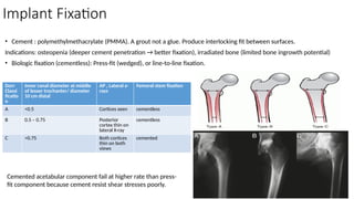 Implant Fixation
• Cement : polymethylmethacrylate (PMMA). A grout not a glue. Produce interlocking fit between surfaces.
Indications: osteopenia (deeper cement penetration → better fixation), irradiated bone (limited bone ingrowth potential)
• Biologic fixation (cementless): Press-fit (wedged), or line-to-line fixation.
Dorr
Classi
ficatio
n
Inner canal diameter at middle
of lesser trochanter/ diameter
10 cm distal
AP , Lateral x-
rays
Femoral stem fixation
A <0.5 Cortices seen cementless
B 0.5 – 0.75 Posterior
cortex thin on
lateral X-ray
cementless
C >0.75 Both cortices
thin on both
views
cemented
Cemented acetabular component fail at higher rate than press-
fit component because cement resist shear stresses poorly.
 