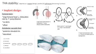 THA stability: depends on: implant (design, position) & soft tissues (tensioning, function).
• Implant design:
Femoral stem:
*large femoral head ↓ dislocation
rate by ↑ jump distance
*no skirts
*offset
Acetabular cup poly liner:
*posterior elevated rim
*lateralized
↑ head-neck diameters ratio
→ ↑ the arc of motion prior to
impingement
Skirts used to ↑ neck length
→ ↓ head –neck diameter
ratio
Large head seated deeper in
acetabulum ↑ jump
distance before dislocation
 