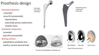 Prosthesis design
Femoral component:
cemented
press-fit (uncemented):
tapered stems
extensively porous coated stems
modular stems
Acetabular component:
cemented
press-fit (uncemented)
Bearing surfaces:
polyethylene acetabular liner
metal or ceramic femoral head
Cemented
stem with a
centralizer
Extensively porous
coated stem
proximally
Press-fit and polyethylene acetabular cup
Types of bearing surfaces
 