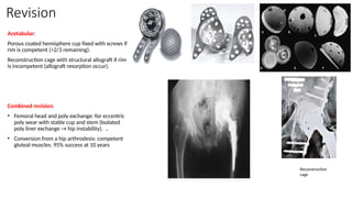 Revision
Acetabular:
Porous coated hemisphere cup fixed with screws if
rim is competent (>2/3 remaining).
Reconstruction cage with structural allograft if rim
is incompetent (allograft resorption occur).
Combined revision:
• Femoral head and poly exchange: for eccentric
poly wear with stable cup and stem (Isolated
poly liner exchange → hip instability). ..
• Conversion from a hip arthrodesis: competent
gluteal muscles. 95% success at 10 years
Reconstruction
cage
 