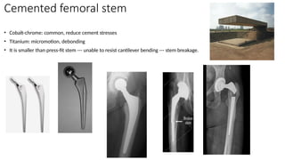 Cemented femoral stem
• Cobalt-chrome: common, reduce cement stresses
• Titanium: micromotion, debonding
• It is smaller than press-fit stem --- unable to resist cantilever bending --- stem breakage.
 