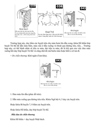 Trường hợp này, day bấm các huyệt trên cho máu bơm lên đầu xong, khóa Hổ khẩu bóp
huyệt Tứ thế để dẫn máu bầm, máu xấu ở đầu xuống và thoát qua đường tiêu, tiểu… Trường
hợp này, có thể bệnh nhân sẽ tiểu ra máu, đại tiện ra máu, đó là kết quả của việc đưa máu
xuống khi day bóp huyệt Tứ thế và cũng nhờ đó mà bướu máu hoặc khối u sẽ tan đi.
+ Do chấn thương: Khô ngân (Tam kha).
1. Đưa máu lên đầu (phác đồ trên).
2. Dẫn máu xuống qua đường tiêu tiểu: Khóa Ngũ bội 4, 5 day các huyệt trên.
Hoặc khóa Bí huyền 7, 8 bấm các huyệt trên.
Hoặc khóa Hổ khẩu, day bóp huyệt Tứ thế.
. Đầu đau do chấn thương
Khóa Hổ khẩu + day huyệt Nhật bách.
 