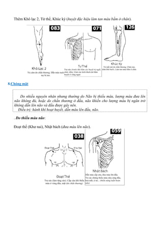 Thêm Khô lạc 2, Tứ thế, Khúc kỳ (huyệt đặc hiệu làm tan máu bầm ở chân).
8.Chóng mặt
Do nhiều nguyên nhân nhưng thường do Não bị thiếu máu, lượng máu đưa lên
não không đủ, hoặc do chấn thương ở đầu, não khiến cho lượng máu bị ngăn trở
không dẫn lên não và đầu được gây nên.
Điều trị: hành khí hoạt huyết, dẫn máu lên đầu, não.
. Do thiếu máu não:
Đoạt thế (Khư nai), Nhật bách (đưa máu lên não).
 