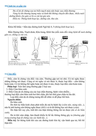 10.Cánh tay co gấp vào
Đa số do di chứng sau tai biến mạch máu não hoặc sau chấn thương.
Vùng bị tổn thương lượng máu và kinh khí không chuyển đến được, thiếu nuôi
dưỡng khiên cho gân cơ bị co rút lại gây nên.
Điều trị: Thông kinh hoạt lạc, dưỡng cân, thư cân.
Khóa Hổ khẩu + bấm dọc đường kinh Ngũ bội 4, 5 (thông kinh hoạt lạc).
Bấm Dương hữu, Trạch đoán, Khư trung, Khôi lâu (dẫn máu đến vùng bệnh để nuôi dưỡng
gân cơ, chống co rút cơ).
11.Câm điếc
Điếc, câm là chứng vừa điếc vừa câm. Thường gặp nơi trẻ nhỏ. Có trẻ nghe được
những không nói được. Cũng có trẻ nghe và nói được ít, thuộc loại điếc - câm không
hoàn toàn. Có trẻ không thể nghe hoặc nói được tí nào, thuộc loại điếc câm hoàn toàn.
Phân loại: Trên lâm sàng thường gặp 2 loại sau:
1- Điếc Câm bẩm sinh.
2- Điếc Câm do di chứng của các loại chấn thương, bệnh viêm nhiễm...
thường loại điếc câm bẩm sinh hơi khó chữa, đòi hỏi thời gian chữa trị lâu dài.
Loại điếc câm do di chứng tương đối dễ chữa và dễ phục hồi hơn.
Nguyên nhân:
Do bẩm sinh.
Do thời kỳ thần kinh chưa phát triển đủ mà bị bệnh lây (viêm não, màng não...),
não bị ảnh hưởng nên không nghe được (điếc) và từ đó không học nói được (câm).
Do thận khí suy yếu, tinh khí của thận không thông lên tai được (đa số do bẩm
sinh).
Do tà khí xâm nhập, làm thanh khiếu bị bế tắc không thông gây ra (thường gặp
trong trường hợp di chứng của các bệnh lây...).
Điều trị: Sơ thông kinh khí của các đường kinh liên hệ, vận hành qua tai, bồi bổ
thận khí.
 