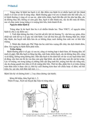 20.Hạch cổ
Tràng nhạc là bệnh lao hạch ở cổ, đặc điểm của bệnh là có nhiều hạch nổi lên thành
chuỗi ở cổ nên có tên là tràng nhạc. Bệnh thường gặp ở trẻ em và thanh niên thể chất yếu, vị
trí bệnh thường ở vùng cổ và sau tai, .phát triển chậm, hạch bắt đầu nổi lên như hạt đậu, sắc
da không thay đồi, không có cảm giác đau, hạch to dần thành mủ, sắc da đổi màu đỏ thâm,
mủ vỡ chày nước trong loãng ri rỉ miệng khó liền, hình thành lỗ dò.
Nguyên nhân bệnh lý
Tràng nhạc là do hạch lâm ba ở cổ nhiễm khuẩn lao. Theo YHCT, về nguyên nhân
bệnh lý chú ý các điểm sau :
1. Tinh thần không thư thái, Can khí uất kết, khí trệ thương Tỳ, vận hóa suy giảm, đờm
nhiệt nội sinh kết tụ ở cổ gáy mà sinh bệnh. Can uất hóa hỏa gây tổn thượng thận âm, nhiệt
độc thịnh, âm huyết mất điều hòa da cơ không được nuôi dưỡng hóa sinh mủ và khó liền
miệng.
2. Nhiệt độc thịnh gây Phế Thận âm hư sinh hỏa vượng đốt cháy tân dịch thành đờm,
đờm hỏa ngưng tụ bệnh thêm phát triển.
Triệu chứng
Bệnh thường phát ở cổ gáy và sau tai, cũng có trường hợp ở dưới hàm, hố thượng đòn, hố
nách (ít gặp). Bắt đầu hạch to bằng hạt đậu, một hoặc nhiều hạch, sắc da không thay đối, cứng
và di động, không nóng không đau. Dần dần hạch to lên dính kết với da và các hạch khác khó
di động; nếu làm mủ thì ấn vào đau cảm giác bập bềnh, sắc da đổi màu xam đỏ mà hơi nóng.
Lúc vỡ miệng, mủ trong loãng có những chất cặn lắng tanh hôi, miệng loét thịt sắc trắng nâu,
sắc da chung quanh tím xẫm có lỗ dò miệng khó liền. Thời kỳ đầu, phần lớn ít có triệu chứng
toàn thân (nên ít được chú ý), thời kỳ cuối thường kèm theo sốt chiều hoặc về đêm, mồ hôi
trộm, ho, sụt cân, tinh thần mệt mỏi, v.v...
Bệnh liên hệ với đường kinh 1, 2 tay (theo đường vận hành).
Khóa Hổ khẩu, bấm Ngũ bội 1, 2.
Thêm Ô mạc, Xích tuế (huyệt đặc hiệu trị tràng nhạc).
 