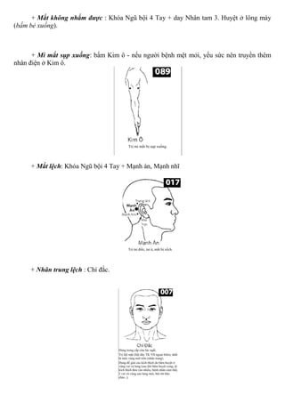 + Mắt không nhắm được : Khóa Ngũ bội 4 Tay + day Nhân tam 3. Huyệt ở lông mày
(bấm bẻ xuống).
+ Mi mắt sụp xuống: bấm Kim ô - nếu người bệnh mệt mỏi, yếu sức nên truyền thêm
nhân điện ở Kim ô.
+ Mắt lệch: Khóa Ngũ bội 4 Tay + Mạnh án, Mạnh nhĩ
+ Nhân trung lệch : Chí đắc.
 