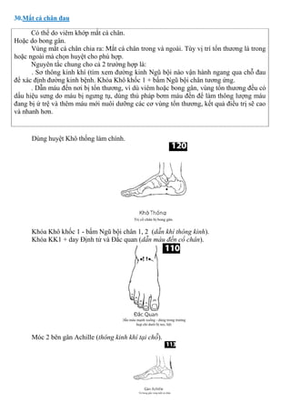 30.Mắt cá chân đau
Có thể do viêm khớp mắt cá chân.
Hoặc do bong gân.
Vùng mắt cá chân chia ra: Mắt cá chân trong và ngoài. Tùy vị trí tổn thương là trong
hoặc ngoài mà chọn huyệt cho phù hợp.
Nguyên tắc chung cho cả 2 trường hợp là:
. Sơ thông kinh khí (tìm xem đường kinh Ngũ bội nào vận hành ngang qua chỗ đau
để xác định đường kinh bệnh. Khóa Khô khốc 1 + bấm Ngũ bội chân tương ứng.
. Dẫn máu đến nơi bị tổn thương, vì dù viêm hoặc bong gân, vùng tổn thương đều có
dấu hiệu sưng do máu bị ngưng tụ, dùng thủ pháp bơm máu đến để làm thông lượng máu
đang bị ứ trệ và thêm máu mới nuôi dưỡng các cơ vùng tổn thương, kết quả điều trị sẽ cao
và nhanh hơn.
Dùng huyệt Khô thống làm chính.
Khóa Khô khốc 1 - bấm Ngũ bội chân 1, 2 (dẫn khí thông kinh).
Khóa KK1 + day Định tử và Đắc quan (dẫn máu đến cổ chân).
Móc 2 bên gân Achille (thông kinh khí tại chỗ).
 